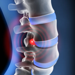 Herniated Disc - Chiropractic Care